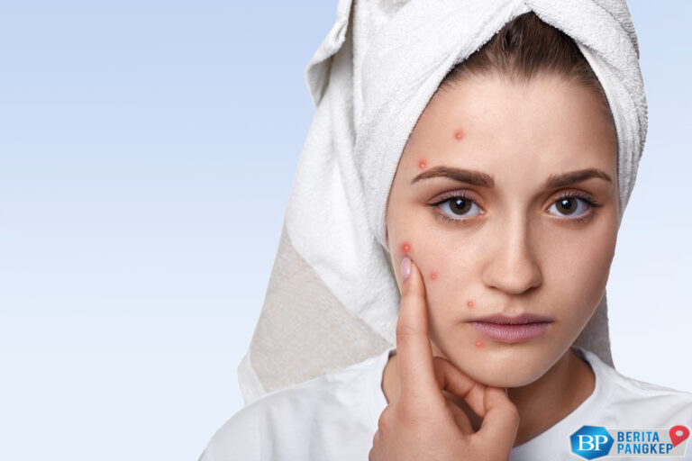 7-makanan-yang-picu-jerawat-paling-cepat-hindari