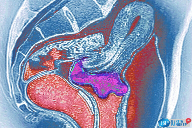 jangan-abai-kanker-serviks-mematikan-kenali-4-gejala-stadium-lanjut