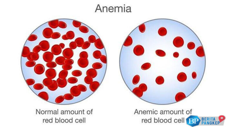 19-juta-warga-ri-derita-anemia-ternyata-dampaknya-ke-otak-bikin-ngeri